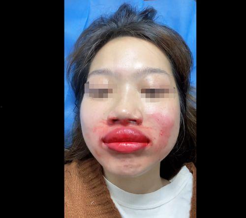 嘴唇肿的图片,成因与应对策略